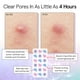 thumbnail image 3 of Parches para espinillas Pore Strip, hidrocoloide Grace & Stella, 72 unidades, 3 of 9