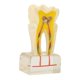 thumbnail image 2 of Modelo de Caries Dental Estudio Modelo de Dientes Estándar Demostración Patológico Educativo Herramientas de Enseñanza de Dientes 6 Veces Caries Modelo de Dientes Suministros ANGGREK  Otros, 2 of 8