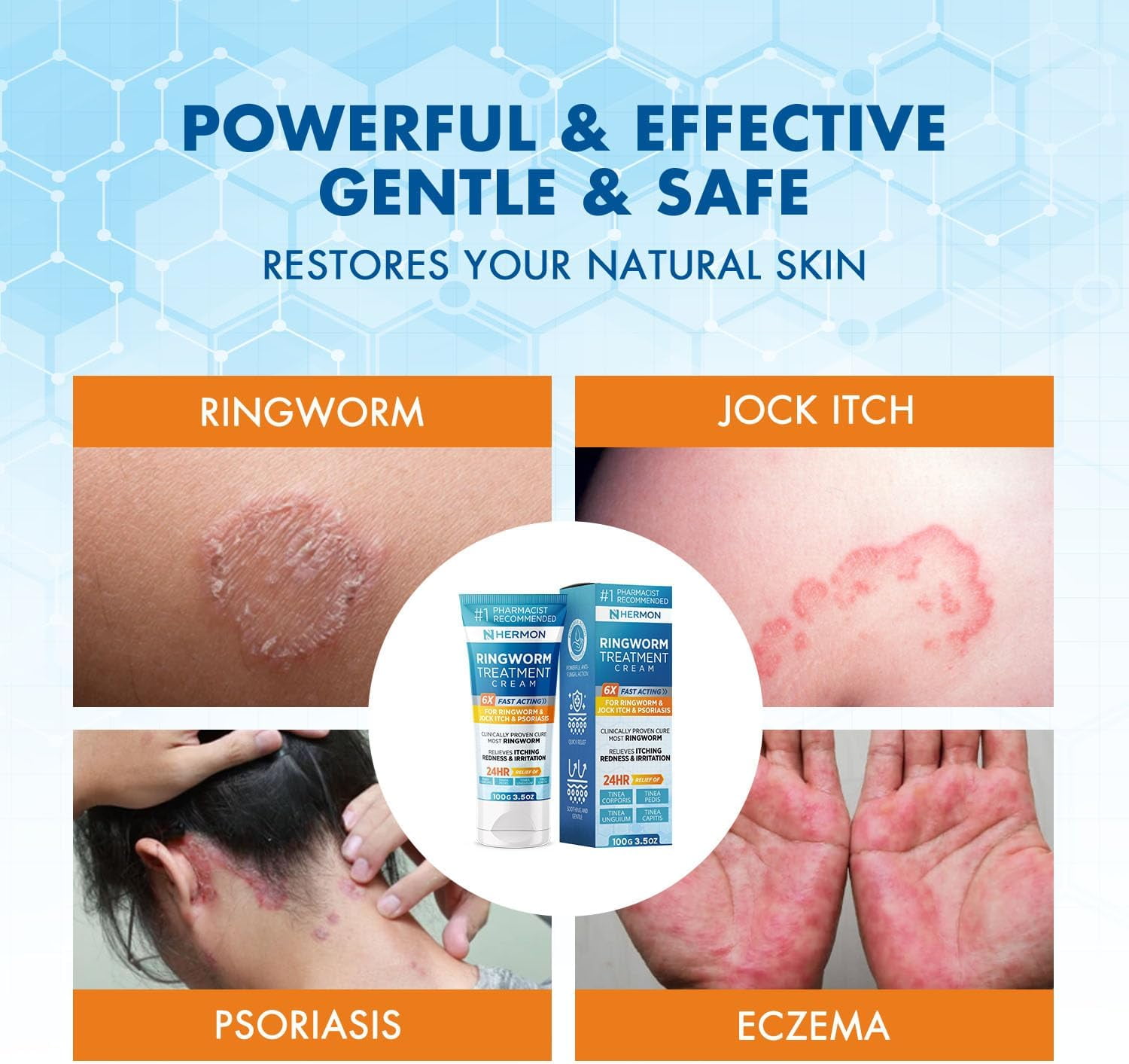 Hermon Powerful Antifungal Ringworm Cream - Treatment for Ringworm, Jock Itch, Eczema, Tinea Versicolor, Athlete's Foot  - 100ml