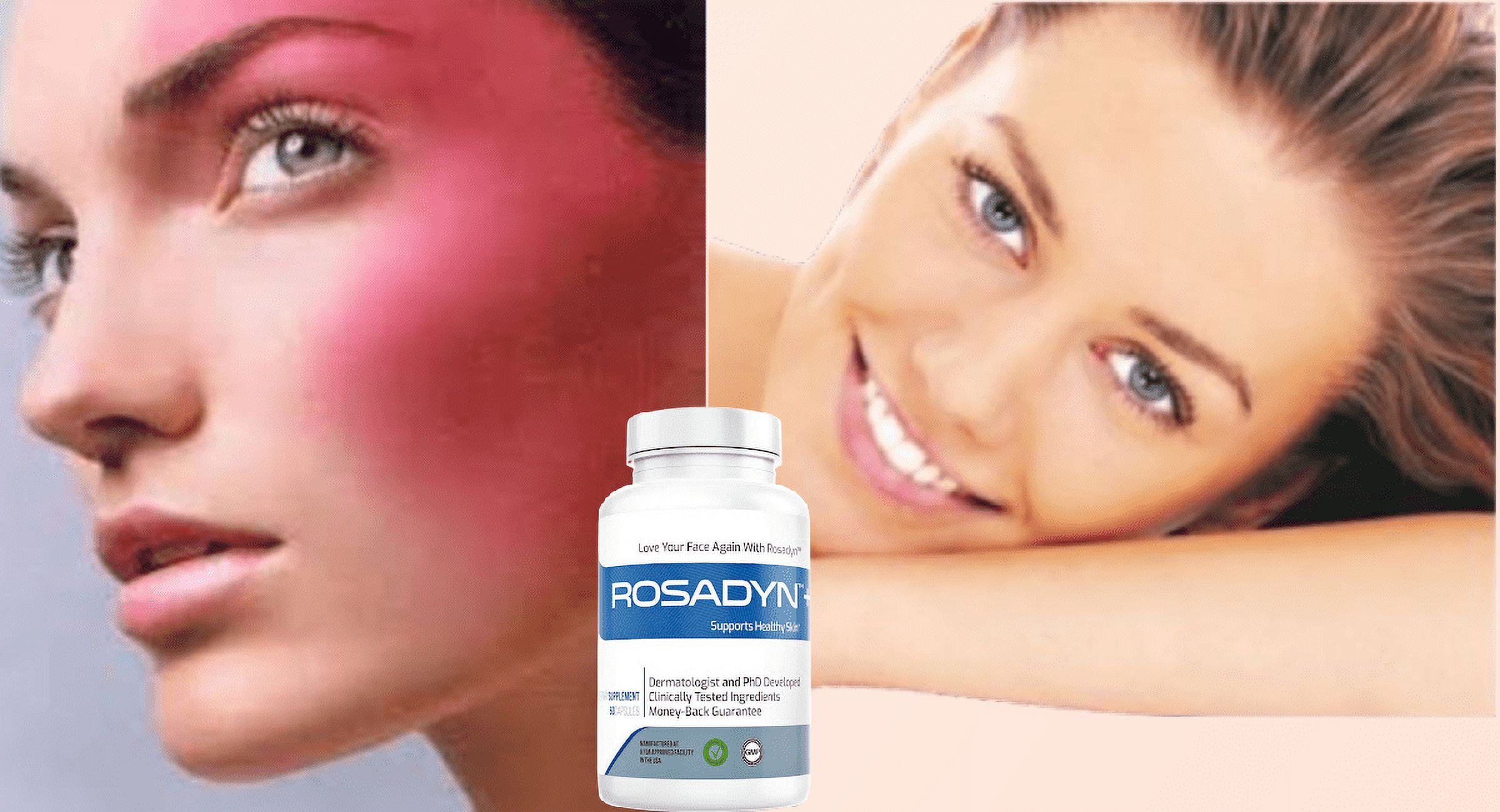 Rosacea Treatment Supplement by Rosadyn | Relief for Face & Nose Redness, Acne and Bloodshot Eyes | 3 Pack