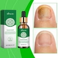 30ml Kerassentials Toenail Treatment Oil,Kerassentials for Toe Nail