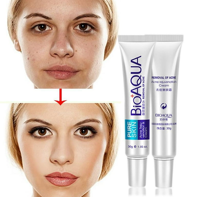 Bioaqua removal of acne outlet