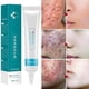thumbnail image 2 of 20g Anti Acne Cream Acne Scar Removal Gel Whitening Moisturizing Shrink Pores Cream for Face Skin Care, 2 of 4