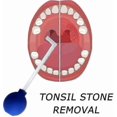 thumbnail image 2 of Tonsil Stone Remover Vacuum, Tonsil Stone Removal Kit Tool Tonsil Stone Treatment Oral Suction Tool, Dental Suction Mouth Cleaner Mouth Cleaning Oral, 2 of 4