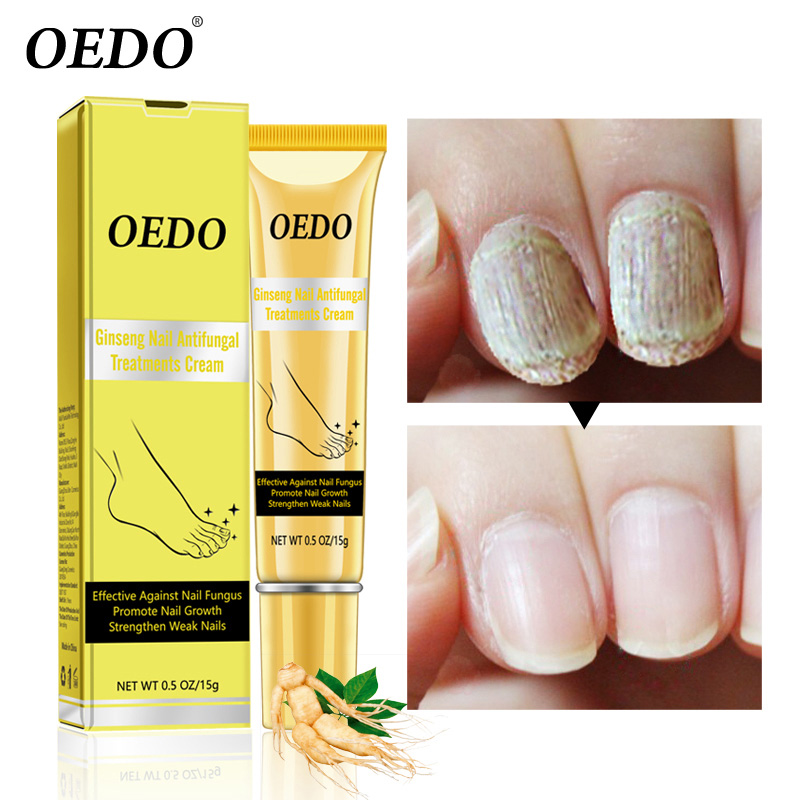 Ginseng Nail Antifungal Treatment Cream Herbal Removal Fungus Toe Anti Infection Foot Care Ointment