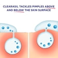 thumbnail image 6 of clearasil ultra 5in1 exfoliating wash, 6.78 oz. (pack of 2), 6 of 7