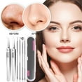 thumbnail image 4 of Xihbxyly Kit de Eliminación de Puntos Negros, Extractores Profesionales de Acero Inoxidable, Mango Antideslizante, Estuche Portátil, Rutina de Cuidado de La Piel, Artículos Esenciales de Belleza para, 4 of 6