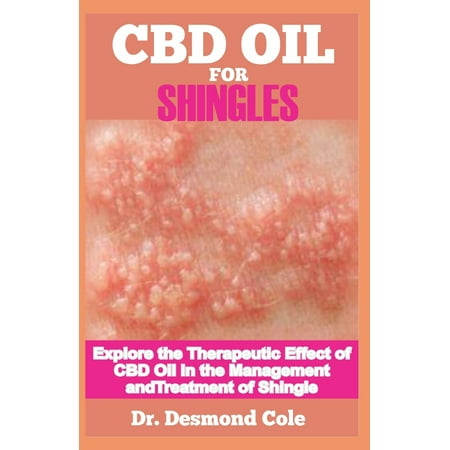 CBD Oil for Shingles: Your Therapeutic Effect of CBD Oil in the Management and Treatment of Shingles