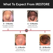 iRestore Laser Hair Growth System FDA Cleared Hair Loss Treatment for Men and Women