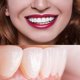 thumbnail image 2 of Sonrisa Snap On False Teeth Carillas dentales superiores e inferiores Dentaduras Juego de cubierta de dientes, 2 of 4