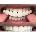 thumbnail image 3 of Upper/lower Whitening Denture Braces, 3 of 5
