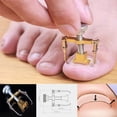 thumbnail image 3 of Professional Ingrown Toenail Toe Fixer Recover Correction Device Protector Tool Pedicure Foot Nail Care, Gold, 3 of 4
