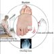 thumbnail image 2 of Gel Toe Separators,10 Pack Pinky Toe Spacers For Overlapping Toes, Bunions, Big Toe Alignment,hammer Toe Straighteners New Arrival, 2 of 5