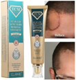 thumbnail image 2 of Crema para eliminar cicatrices quirúrgicas quemadas, Gel que se desvanece, reparación del acné, marcas de viruela, estrías, cicatriz de cesárea brillante, cuidado de la piel suave, 30g, 2 of 5