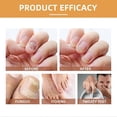 thumbnail image 5 of 20ml Bee-Venom Nailfungus Soothing Spray Advanced Nail Repair Spray Toenail Treatments for Damage Nails, 5 of 5