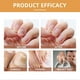 thumbnail image 5 of 20ml Bee-Venom Nailfungus Soothing Spray Advanced Nail Repair Spray Toenail Treatments for Damage Nails, 5 of 5