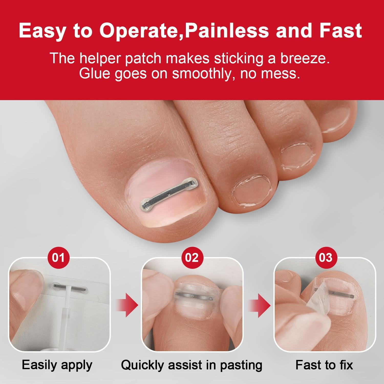 Unimiko Ingrown Toenail Corrector Kit & Curved Nail Repair : Quick & Easy Solution - 6 Pcs (0.71/0.75/0.79in) for Effective Treatment