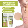 Roycederm Antifungal Cream Treatment for Tinea Versicolor, Athletes Foot, Ringworm