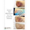 thumbnail image 5 of Kinesio® Classic Fan Cut Tape, 5 of 8