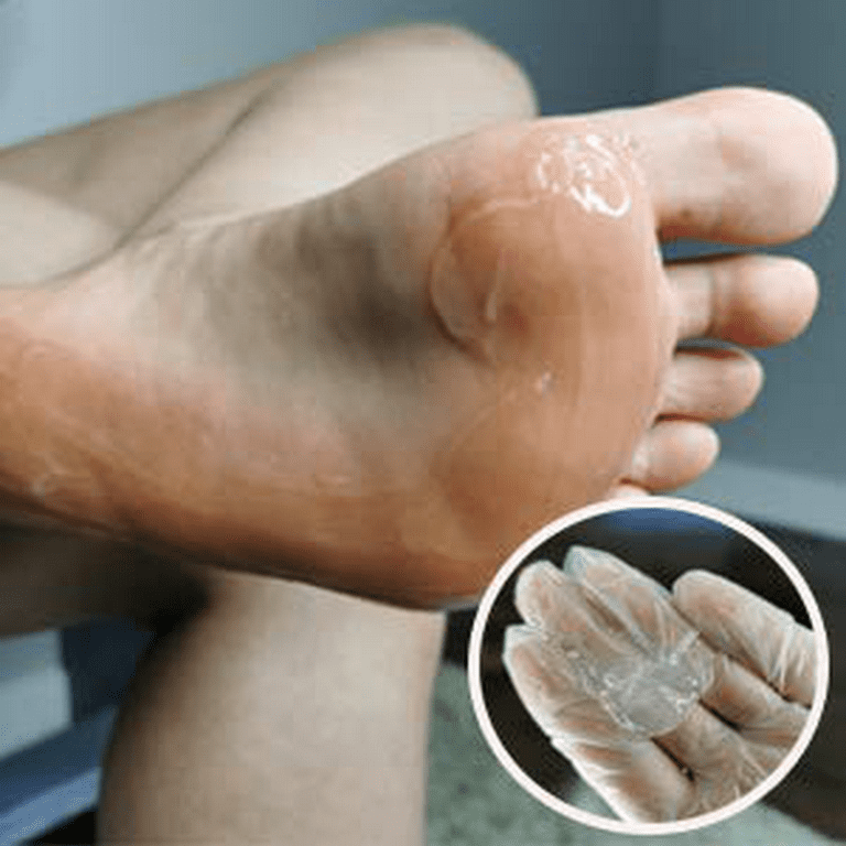 8oz Callus Remover gel for feet for a professional pedicure. Better results  than, foot file, pumice stone, foot scrubber, foot buckets & callus shaver.  Rid ugly callouses from feet in 