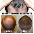 thumbnail image 4 of JAYSUING Hair Growth Roller Safe Painless Titanium Microneedle Roller Strong Root Nourish Scalp Heal, 4 of 5