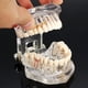 thumbnail image 2 of 2025 Modelos dentales Modelos de resina reparables de dientes enfermos para la enseñanza y la investigación en medicina y enfermedades dentales, 2 of 5