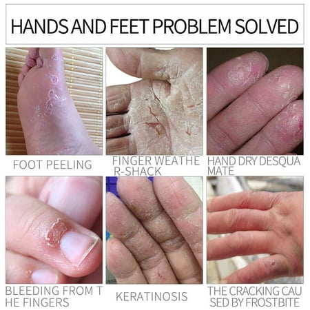 Chapped Hands Remedy (30G Natural Formula Hand Foot Crack Cream Heel Chapped Peeling Foot Hand Repair Anti Dry Crack Skin Care Repair)