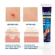 thumbnail image 4 of 20g Crema Tópica Urticaria: Alivio eficaz del picor, calma rápidamente las irritaciones de la piel, recomendada por dermatólogos, 4 of 7