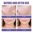 thumbnail image 3 of For Dark Spots From Cosmetics - Post Dark Patch With 144 Micropoints Dermatologist Tested And Non-irritating Not Tested, 3 of 7