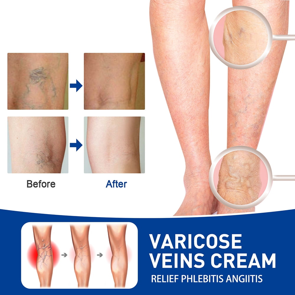 Varicose Veins Treatment Cream Vasculitis Relief Phlebitis Angiitis  Inflammation