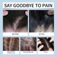 thumbnail image 2 of Seborrheic Dermatitis Cream, Scalp Treatment for Psoriasis, Folliculitis, Dry Scalp, Dandruff, Anti-Itch Cream for Soothing Relief, 2 of 5