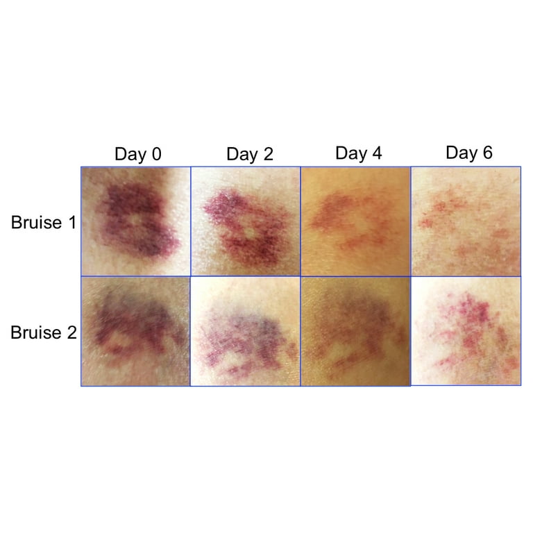 bruise-healing