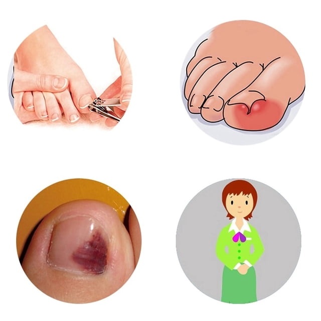 Herramienta para recuperar las uñas de los pies, 12 piezas/caja Herramienta para corregir las uñas de los pies Herramienta para corregir las uñas de los pi