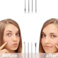 thumbnail image 4 of Juego de herramientas para eliminar puntos negros, 4 piezas, removedor de puntos negros profesional de acero inoxidable para el cuidado facial con estuche, 4 of 5