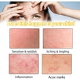 thumbnail image 5 of Crema para tratar el acné Crema para tratar el acné quístico, hormonal y severo Crema para tratar el acné en adolescentes y adultos, 5 of 5