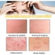 thumbnail image 5 of Crema para tratar el acné Crema para tratar el acné quístico, hormonal y severo Crema para tratar el acné en adolescentes y adultos, 5 of 5