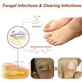 Nail Fungus with Light Therapy Device, Clinically Results