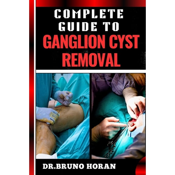 Complete Guide to Ganglion Cyst Removal: Comprehensive Handbook To Expert Techniques, Home Remedies, And Post Surgery Ca, (Paperback)