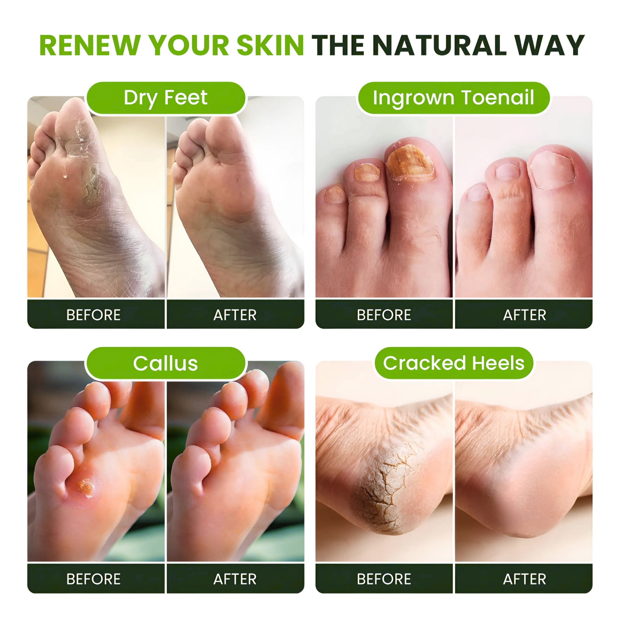 Foot Cure Tea Tree Oil Foot Soak with Epsom Salt for Toenail Fungus, Athlete's Foot, Callus Softening, Foot Odor Scent - 2Pack