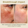 thumbnail image 4 of Crema de melasma ABERA corrector de manchas oscuras, 20 ml, para mujeres y hombres, 4 of 8