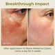 thumbnail image 4 of Crema de melasma ABERA corrector de manchas oscuras, 20 ml, para mujeres y hombres, 4 of 8