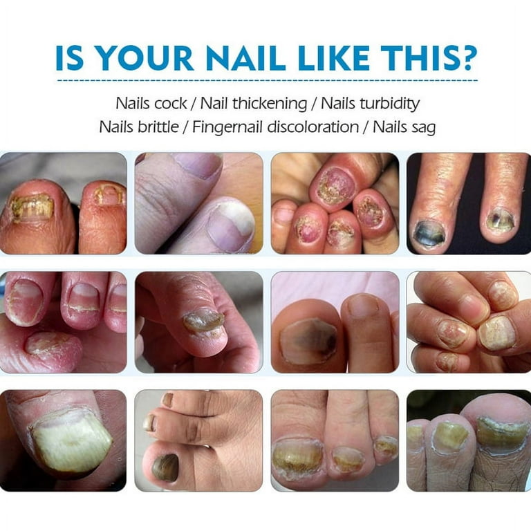Onychomycosis treatment on sale