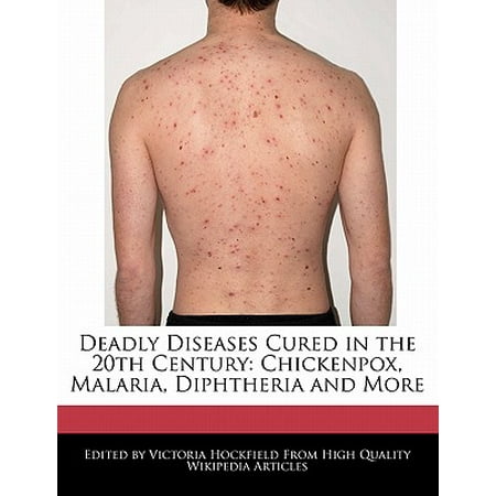 Deadly Diseases Cured in the 20th Century : Chickenpox, Malaria, Diphtheria and