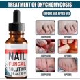 thumbnail image 3 of 2026 Nail Fungal Solution,Nail Repair for Fingernails Toenails, Toe Nail Fungal Treatment Fungal Nail Solution Fixes Nails Safe Effective(30ML), 3 of 5