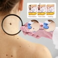 thumbnail image 4 of 1PCS Topo y verruga piel cara axila carne cuello eliminación reparación cuidado de limpieza 10ml, 4 of 5