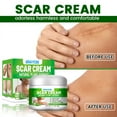 Natural Aloe Vera Scar Fade Cream For Acne Scars, Burns, Surgical