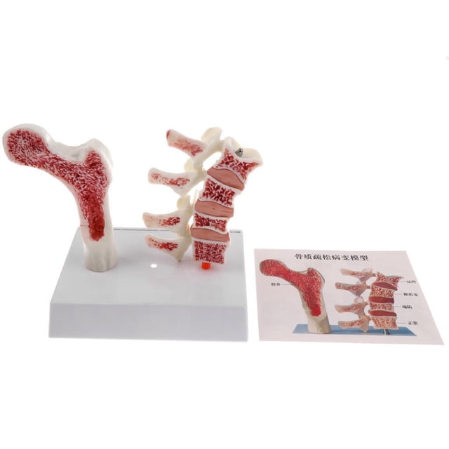 Bewildely Kit de modelo de patología de osteoporosis de hueso del muslo de vértebra Lumbar humana 1:1 Juguetes