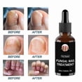 thumbnail image 4 of 2pcs Anti Fungal Nail Treatment Repair Finger Toe Care Nail Fungus Liquid, 4 of 4