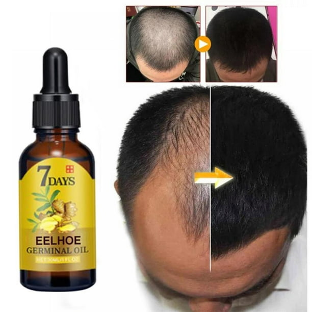 Ginger Germinal Oil, Ginger Hair Growth Essential Serum Stop Hair Loss Hair,  Thinning Treatment Hair Growth Oil for Women & Men 10ML 