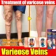 thumbnail image 2 of Vasos sanguíneos de araña, venas varicosas, alivio efectivo de las venas varicosas para aliviar la vasculitis, la flebitis, el tratamiento del dolor de araña, 2 of 5